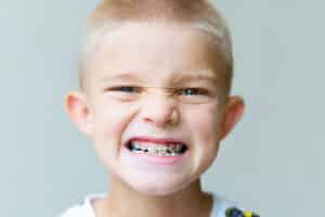 blond haired boy grimaces showing braces close up