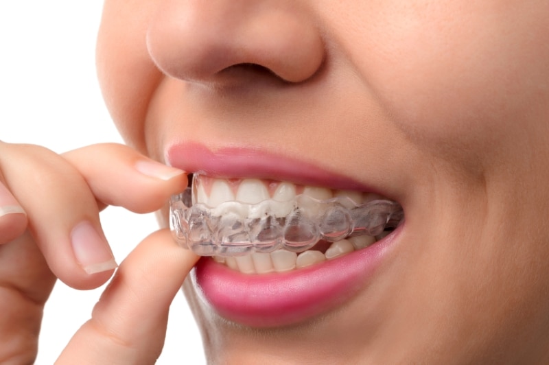 female patient putting clear invisalign teeth aligner on upper teeth