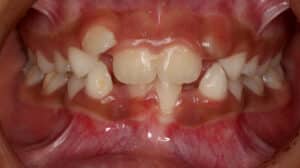 2-Phase Treatment