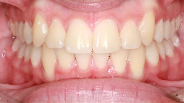 functional class 2 orthodontics