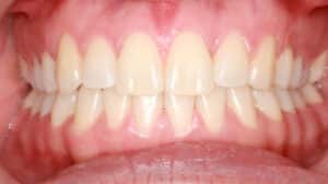 Crossbite