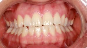 Crossbite