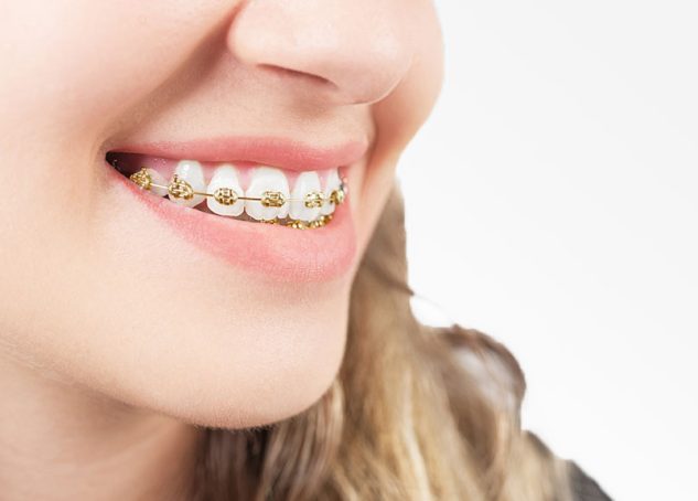 patient smiling showing gold braces